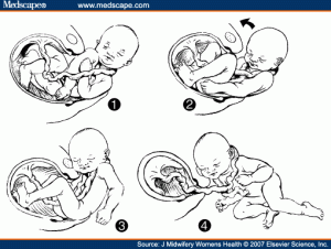 Maniobra de "somersault" Maniobra de "somersault"