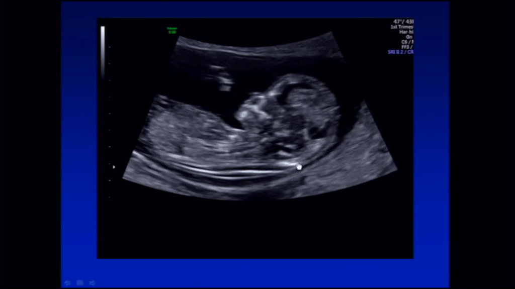 ¿Ecografia o estudio&nbsp;genético?