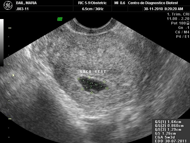 Pérdida precoz del&nbsp;embarazo