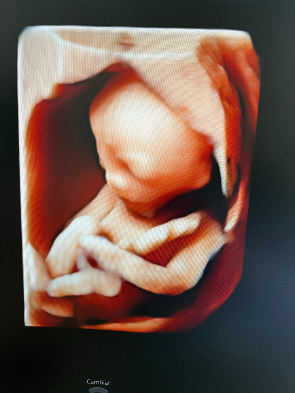 Pre-eclampsia y riesgo&nbsp;cardiovascular