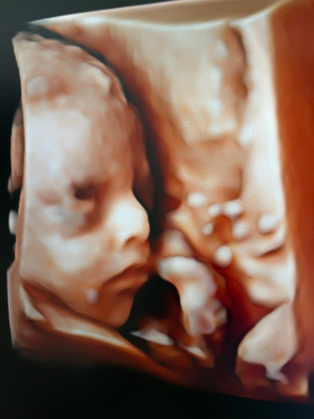 Baja dosis de aspirina y parto&nbsp;prematuro