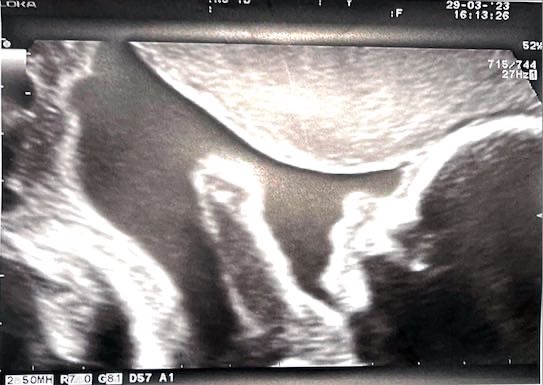 Ecografía en presentación&nbsp;pelviana