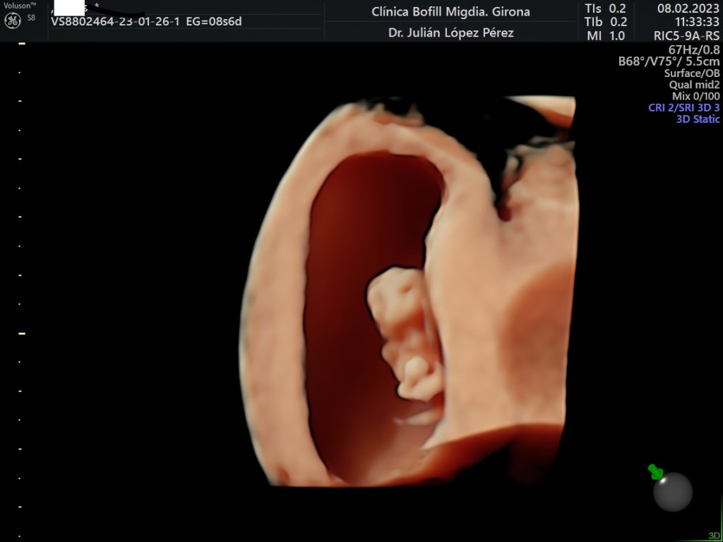 Detección de ploidía en ADN fetal libre