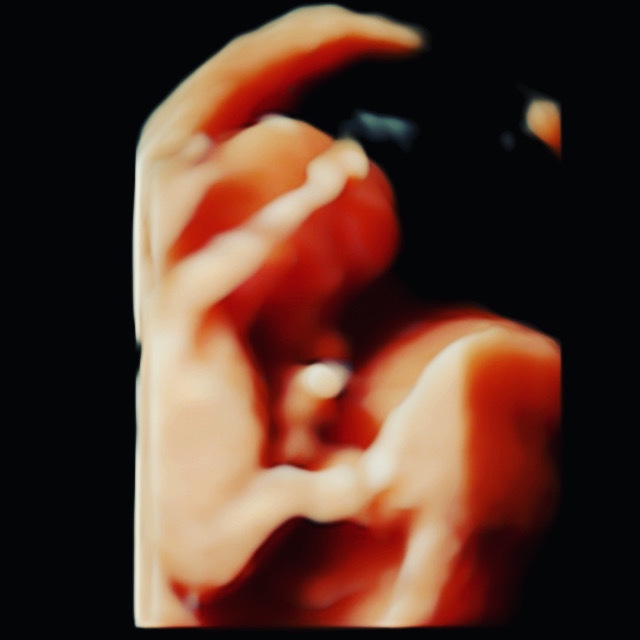 Aspirina hasta las 28&nbsp;semanas