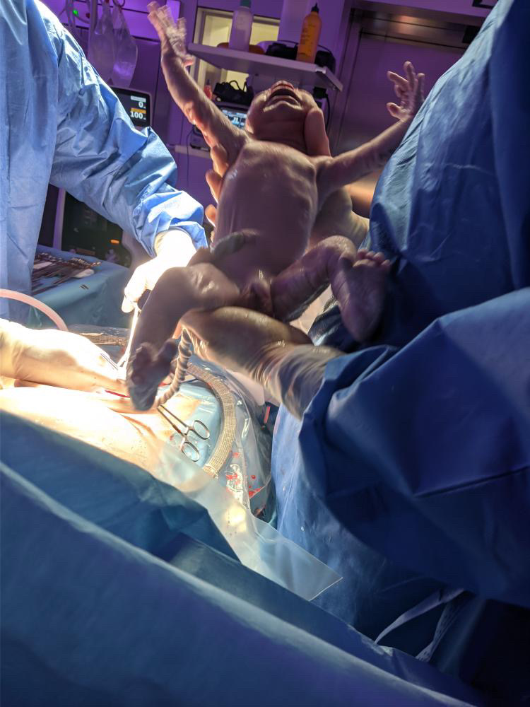 Microbiota y cesárea