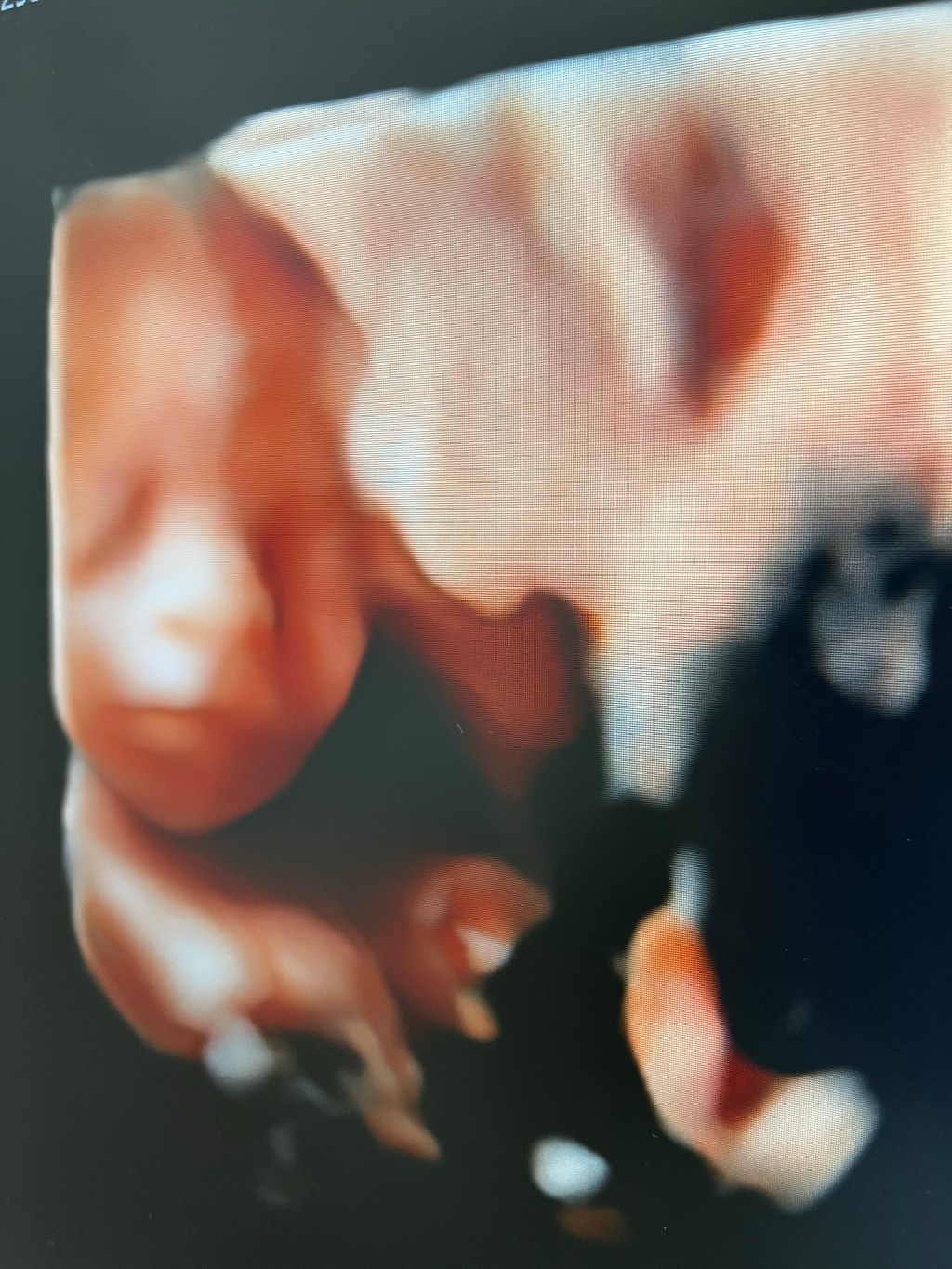 Preeclampsia, puesta al&nbsp;día.