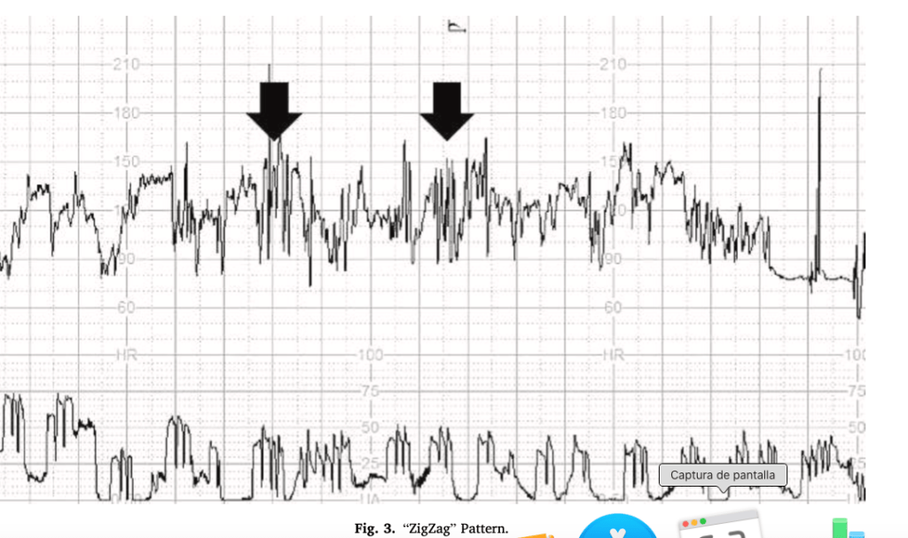 Monitorización fetal intraparto